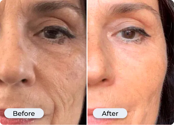 New Glamory MicroLift System 2